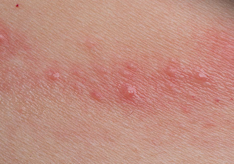 常见皮肤病图片及名称接触性皮炎