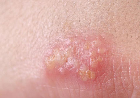 常见皮肤病图片及名称疱疹